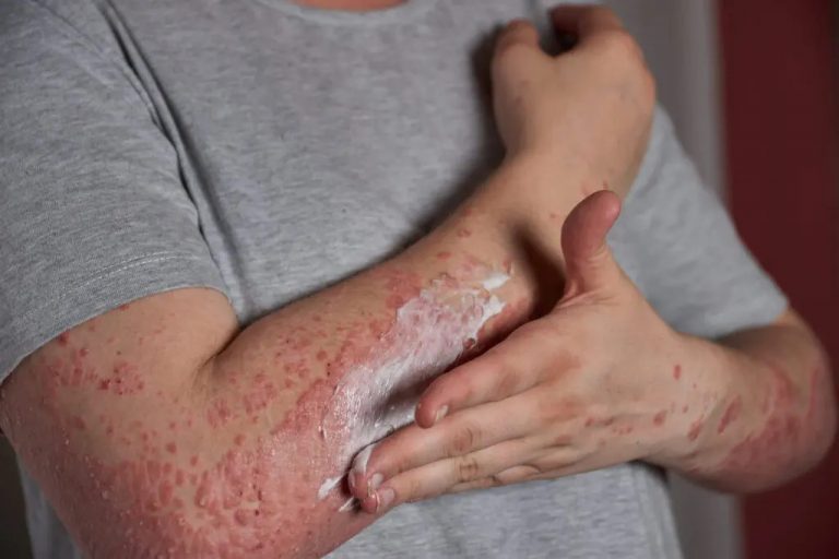 herpes-zoster-o-culebrilla-1-scaled